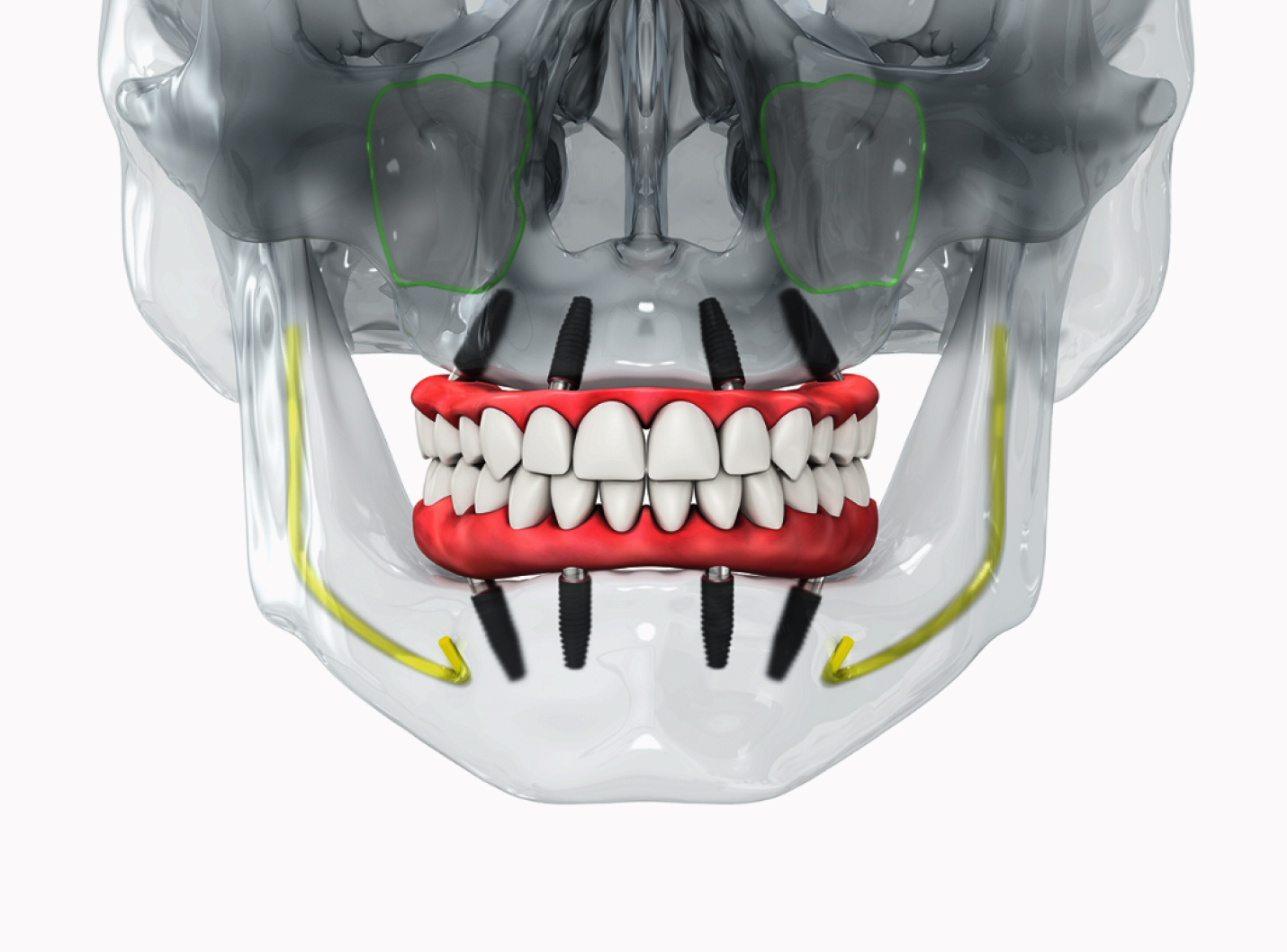 All on X × Pro Archで即日治療